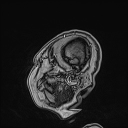 Cavernous sinus meningioma (Radiopaedia 63682-72367 Sagittal T1 C+ 26).jpg