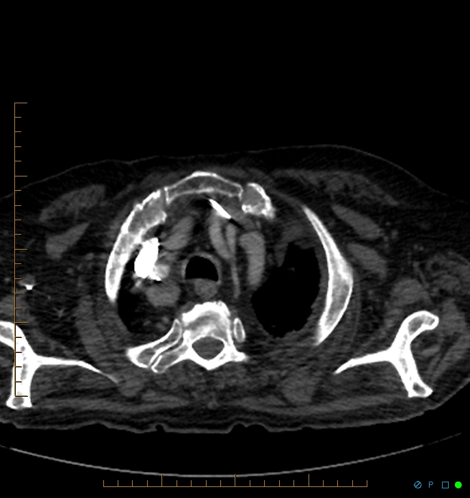 Cavitating pulmonary infarction (Radiopaedia 54634-60849 Axial C+ CTPA 2).jpg