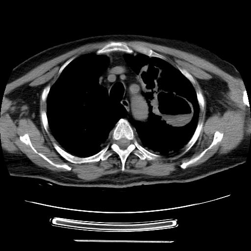 Cavitating pulmonary metastases (Radiopaedia 89545-106544 Axial non-contrast 14).jpg