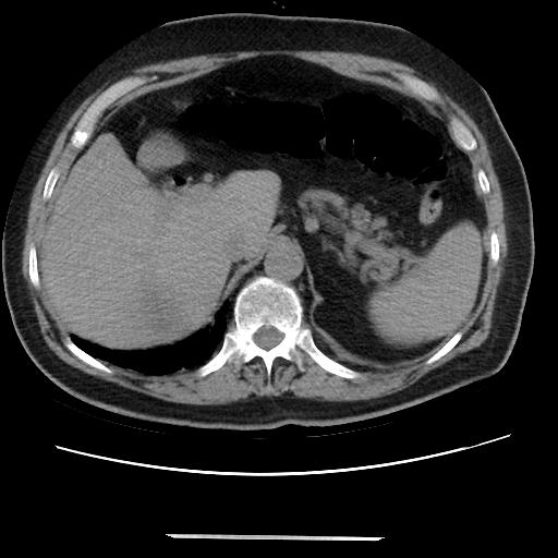 Cavitating pulmonary metastases (Radiopaedia 89545-106544 Axial non-contrast 54).jpg
