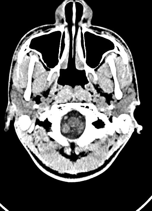 Cavum septum pellucidum and cavum vergae (Radiopaedia 77797-90060 Axial Brain Window 9).jpg