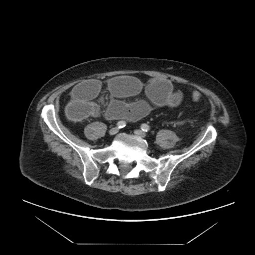 Cecal adenocarcinoma (Radiopaedia 64871-73817 A 68).jpg