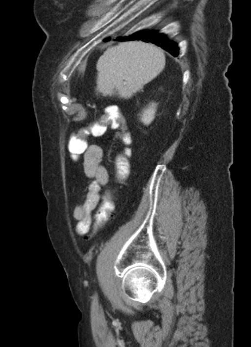 Cecal adenocarcinoma - surgical scar recurrence (Radiopaedia 79988-93264 D 14).jpg