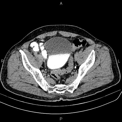 File:Cecal cancer with appendiceal mucocele (Radiopaedia 91080-108651 Axial C+ delayed 67).jpg