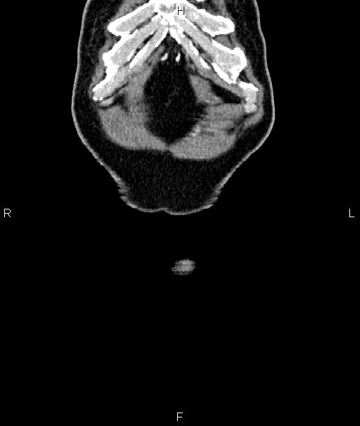 Cecal cancer with appendiceal mucocele (Radiopaedia 91080-108651 D 1).jpg