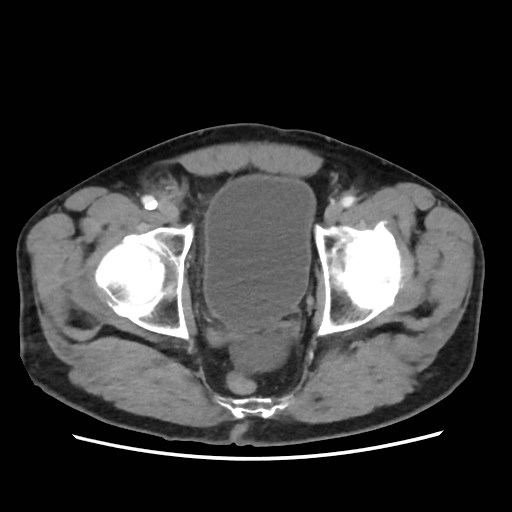 File:Cecal mass causing appendicitis (Radiopaedia 59207-66531 A 81).jpg