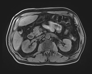 Cecal mass causing appendicitis (Radiopaedia 59207-66532 Axial T1 54).jpg