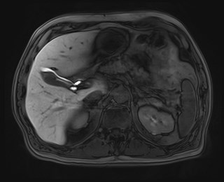 Cecal mass causing appendicitis (Radiopaedia 59207-66532 K 41).jpg