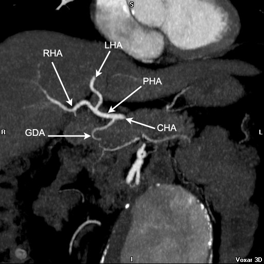 File:Celiac artery anatomy (Radiopaedia 16763-16476 B 1).jpg
