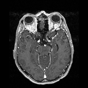 Central-variant posterior reversible encephalopathy syndrome (PRES) (Radiopaedia 43880-47358 Axial T1 C+ 59).jpg