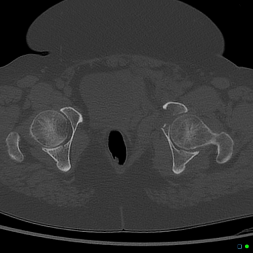 File:Central fracture-dislocation of the acetabulum (Radiopaedia 36578-38150 Axial bone window 65).jpg