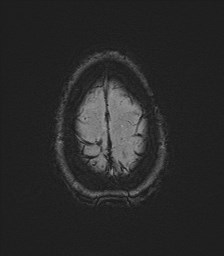 Central neurocytoma (Radiopaedia 84497-99872 Axial SWI 65).jpg