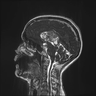 Central neurocytoma (Radiopaedia 84497-99872 Sagittal CISS 37).jpg