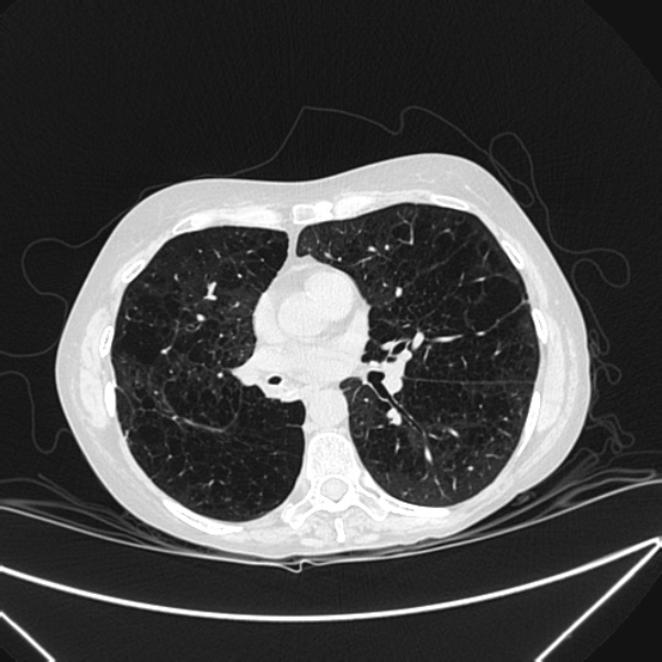 Centrilobular pulmonary emphysema (Radiopaedia 24495-24789 Axial lung window 51).jpg
