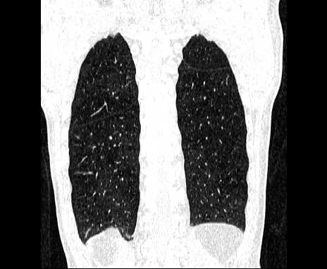 Centrilobular pulmonary emphysema (Radiopaedia 62468-70718 Coronal lung window 61).jpg