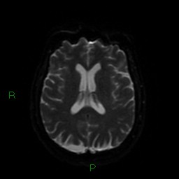 Cerebellar abscess (Radiopaedia 78135-90678 Axial DWI 48).jpg