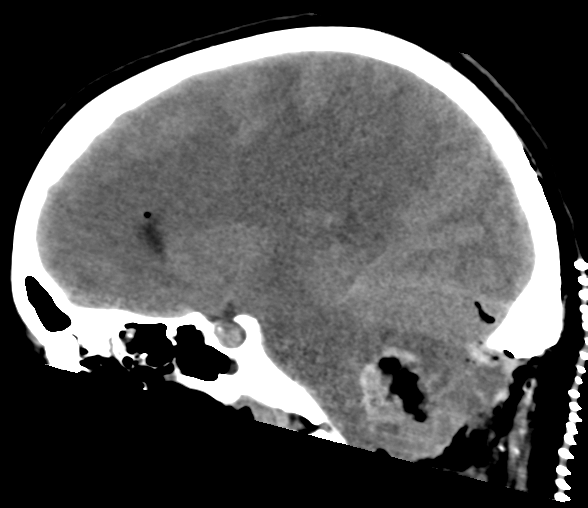 File:Cerebellar ependymoma complicated by post-operative subdural hematoma (Radiopaedia 83322-97737 C 14).png