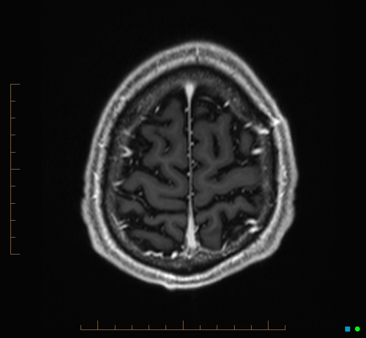 Cerebellar gangliocytoma (Radiopaedia 65377-74422 Axial T1 C+ 128).jpg