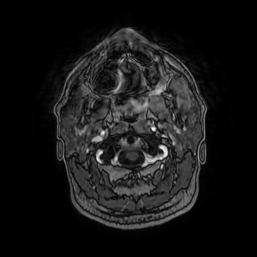 Cerebellar hemangioblastoma (Radiopaedia 88055-104622 Axial T1 C+ 19).jpg