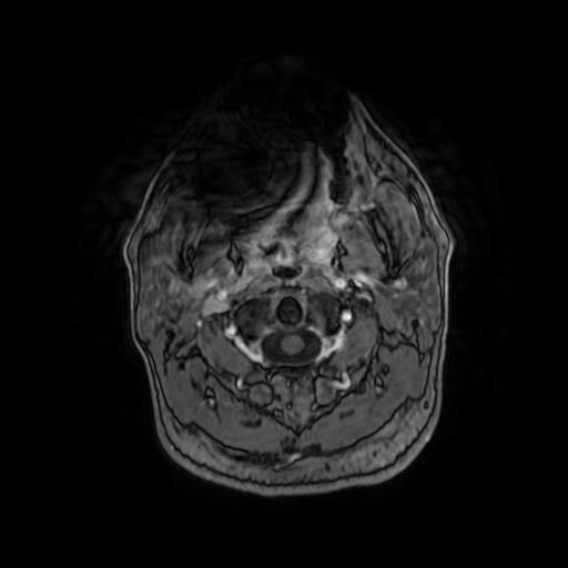 Cerebellar hemangioblastoma (Radiopaedia 88055-104622 Axial T1 C+ 7).jpg