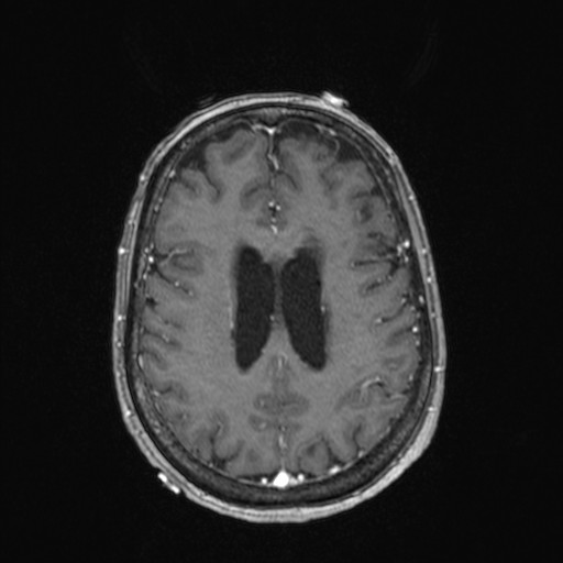 File:Cerebellar metastases (Radiopaedia 24038-24249 Axial T1 C+ 3).jpg