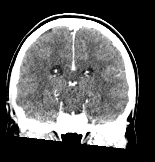 Cerebellar metastases - colorectal adenocarcinoma (Radiopaedia 40947-43652 Coronal C+ 53).png