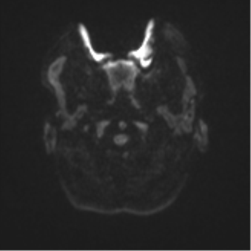 Cerebellar metastasis (Radiopaedia 51137-56765 Axial DWI 30).png