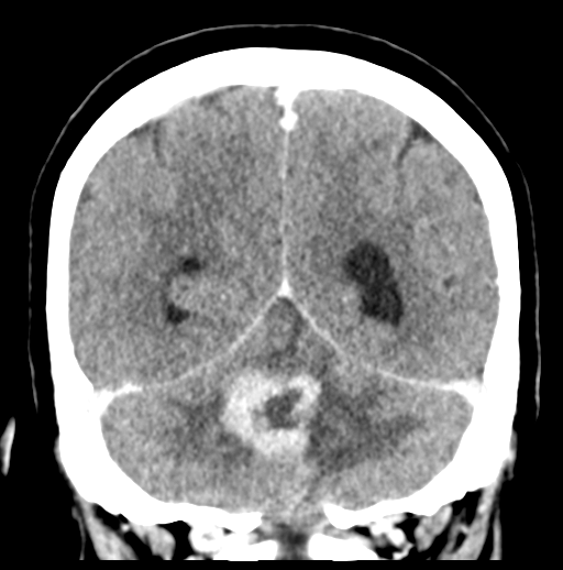 Cerebellar metastasis (Radiopaedia 54578-60812 Coronal C+ 44).png