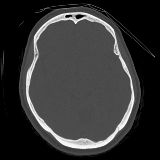 File:Cerebellar metastasis (cystic appearance) (Radiopaedia 41395-44258 Axial bone window 29).png