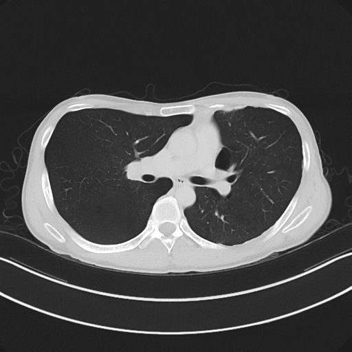 Cerebellar metastasis - adenocarcinoma lung (Radiopaedia 63184-71717 Axial lung window 32).png