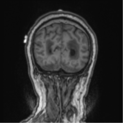 Cerebellar metastasis from lung adenocarcinoma (Radiopaedia 86690-102829 Coronal T1 15).png
