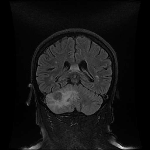 File:Cerebellar metastasis of pulmonary adenocarcinoma, cavernous venous malformation, and developmental venous anomaly (Radiopaedia 85827-101661 Coronal FLAIR 23).jpg