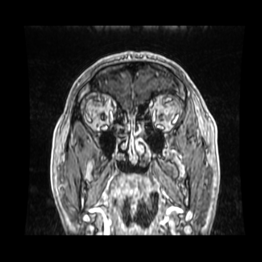 Cerebellar metastasis of pulmonary adenocarcinoma, cavernous venous malformation, and developmental venous anomaly (Radiopaedia 85827-101661 Coronal T1 C+ 79).jpg