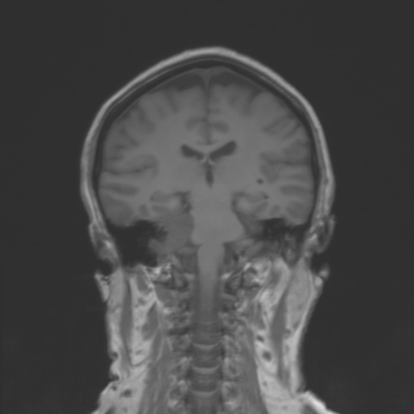 File:Cerebellopontine angle meningioma (Radiopaedia 53561-59591 Coronal T1 14).jpg