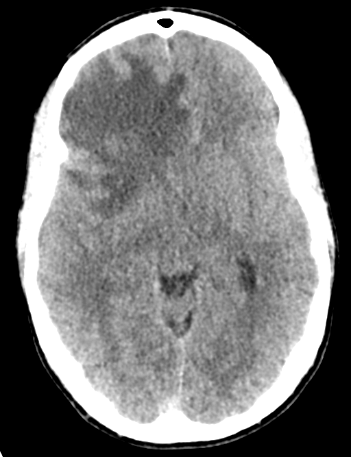 Cerebral abscess (Radiopaedia 60342-68008 Axial non-contrast 24).png