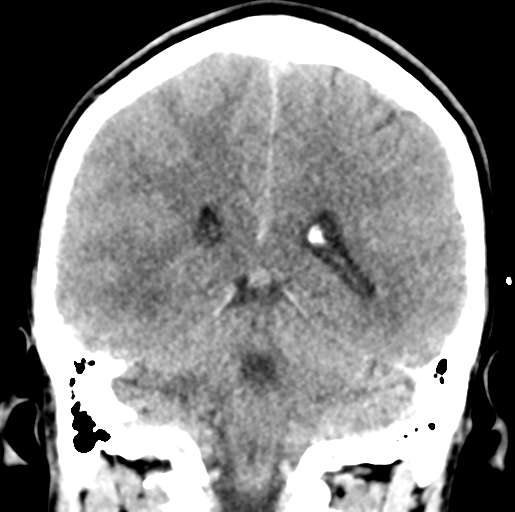Cerebral abscess (Radiopaedia 60342-68008 Coronal non-contrast 42).png
