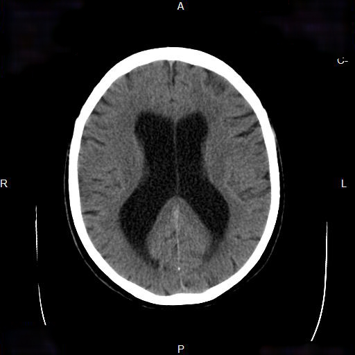 File:Cerebral abscess (Radiopaedia 7606-8431 Axial non-contrast 16).jpg