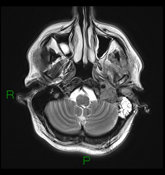 File:Cerebral abscess and subdural empyema (Radiopaedia 84436-99779 Axial T2 4).jpg