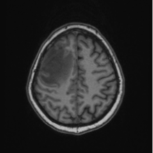 Cerebral abscess from pulmonary arteriovenous malformation (Radiopaedia 86275-102291 Axial T1 57).png