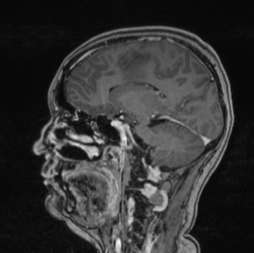 Cerebral abscess from pulmonary arteriovenous malformation (Radiopaedia 86275-102291 Sagittal T1 C+ 45).png