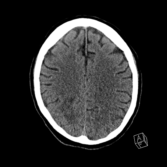 Cerebral abscess with ventriculitis (Radiopaedia 78965-91876 Axial non-contrast 33).jpg