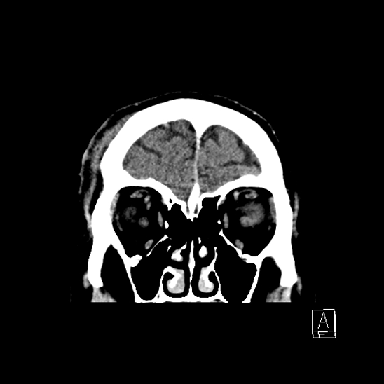 File:Cerebral abscess with ventriculitis (Radiopaedia 78965-91877 B 9).jpg
