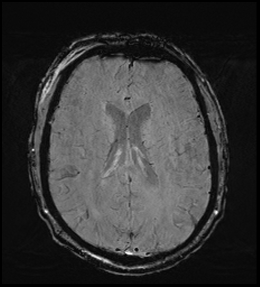 Cerebral abscess with ventriculitis (Radiopaedia 78965-91878 Axial SWI 33).jpg