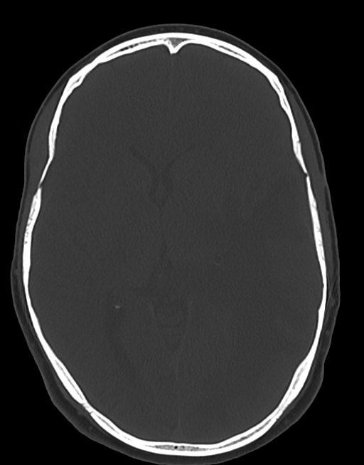 Cerebral abscesses (Radiopaedia 70458-80568 Axial bone window 32).jpg