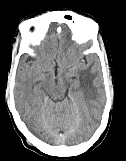Cerebral abscesses (Radiopaedia 70458-80568 Axial non-contrast 26).jpg