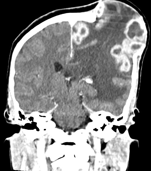 Cerebral abscesses (Radiopaedia 70458-80568 Coronal Contrast 39).jpg