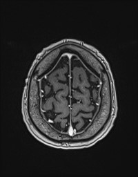 Cerebral amyloid angiopathy-related inflammation (Radiopaedia 58270-65377 Axial T1 C+ fat sat 131).jpg