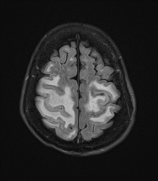 File:Cerebral amyloid angiopathy-related inflammation (Radiopaedia 74836-85849 Axial FLAIR 24).jpg