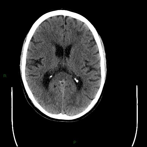 Cerebral amyloid angiopathy (Radiopaedia 77506-89665 Axial non-contrast 59).jpg