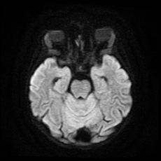 File:Cerebral and spinal tuberculosis (Radiopaedia 90489-107837 Axial DWI 9).jpg